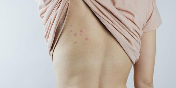 bed bug bites on a woman's back